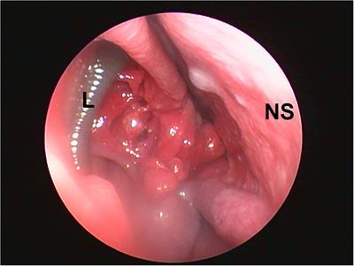 Case Report: Endoscope-Assisted Bilateral Nasal Leech Retrieval in a Dog